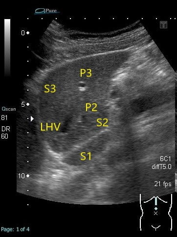 腹部エコー 肝臓 解剖編 臨床検査技師mtもんたの医療ノート