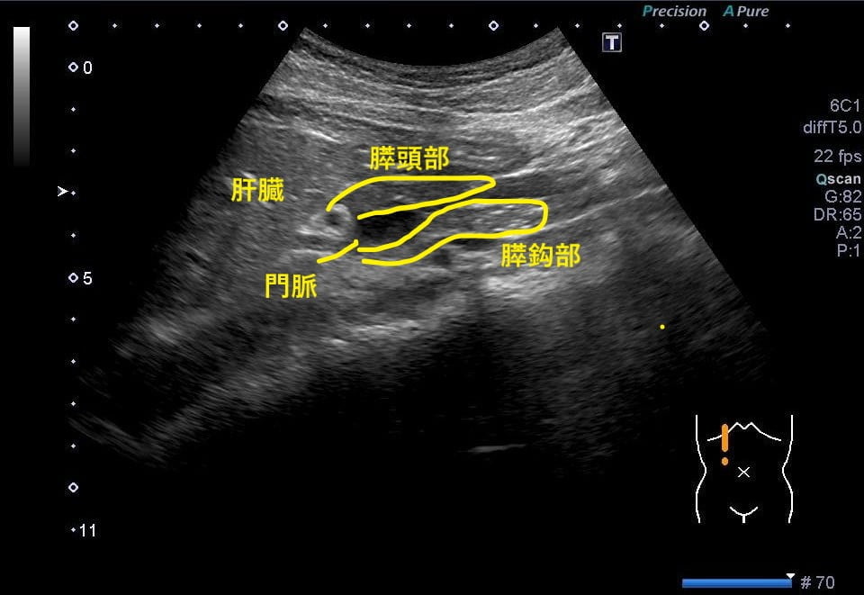 腹部エコー 膵臓 解剖 臨床検査技師mtもんたの医療ノート